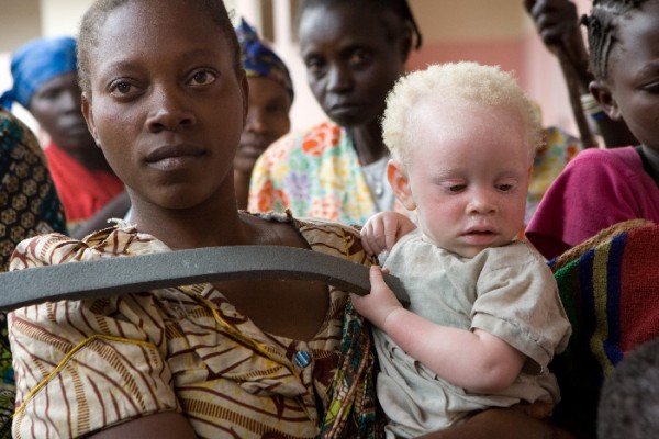 Crianças albinas enfrentam desde bullying na escola até ameaças e agressões físicas. Foto: ONU / Marie Frechon