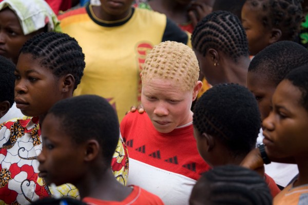 Albinismo é uma condição congênita mais comum na África subsaariana. Foto: ONU/Marie Frechon